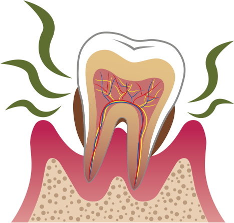 口臭・歯周病