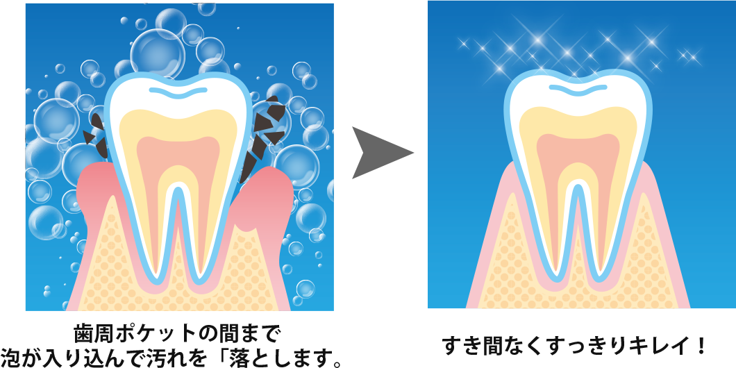 歯周ポケットの間まで泡が入り込んで汚れを「落とします。すき間なくすっきりキレイ！